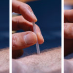 Fig. 2 Inserting the acupuncture needle with tube