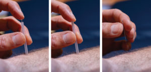 Fig. 2 Inserting the acupuncture needle with tube
