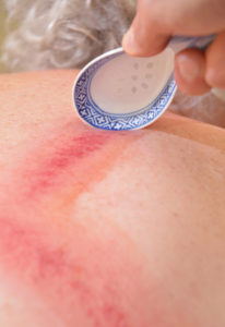 Fig. 5 Gua Sha