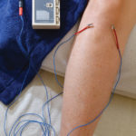 Fig. 8 Electrical stimulation